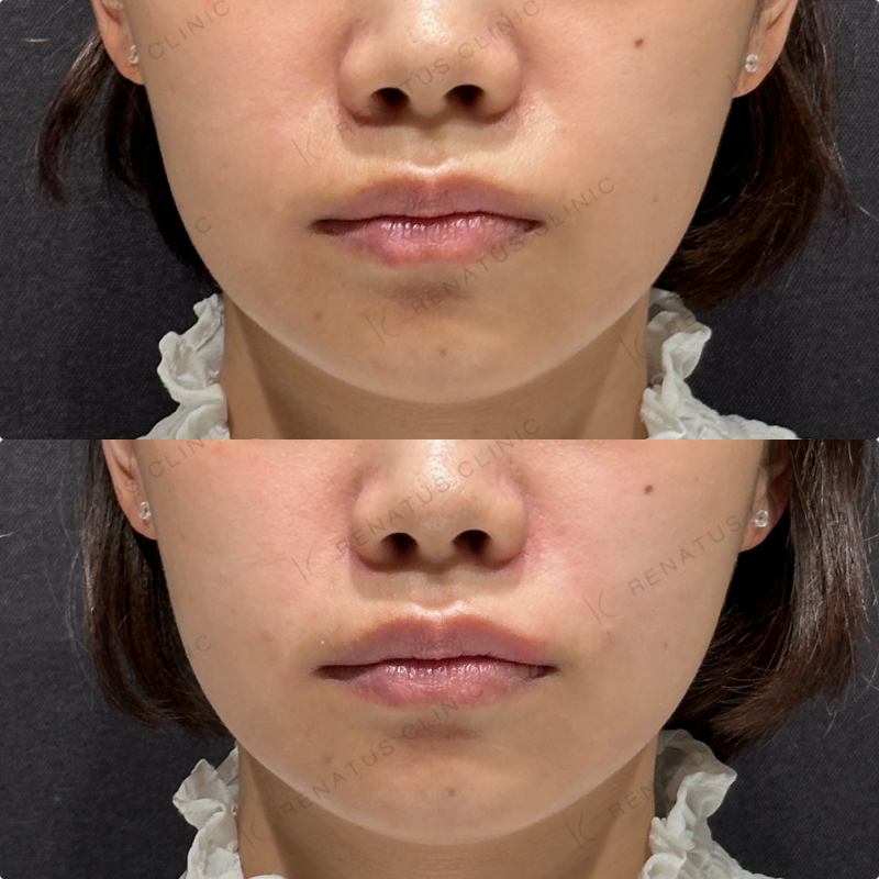 ほうれい線ヒアルロン酸ボリフト症例写真