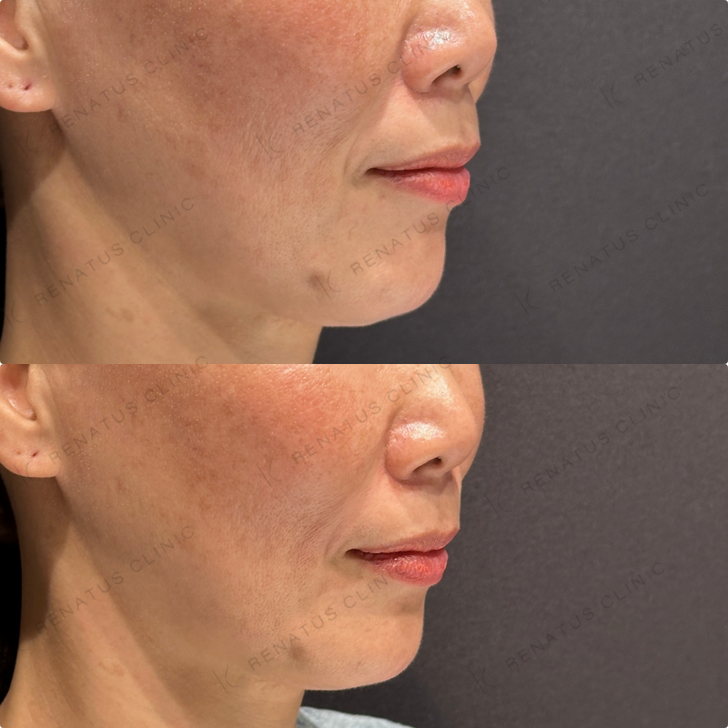 ほうれい線ヒアルロン酸ボリフト症例写真