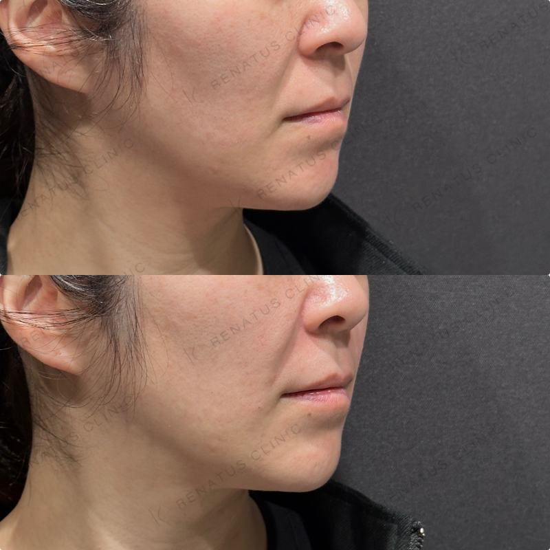 ほうれい線ヒアルロン酸ボリフト症例写真