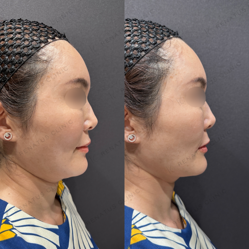 ほうれい線ヒアルロン酸ボリフト症例写真