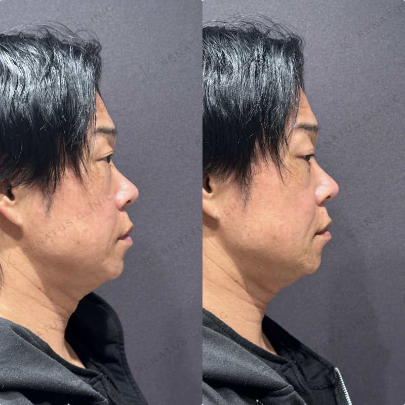 ほうれい線ヒアルロン酸ボリフト症例写真