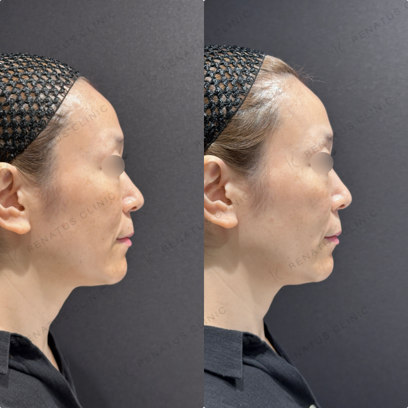 ほうれい線ヒアルロン酸ボリフト症例写真