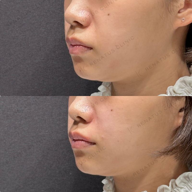 ほうれい線ヒアルロン酸ボリフト症例写真