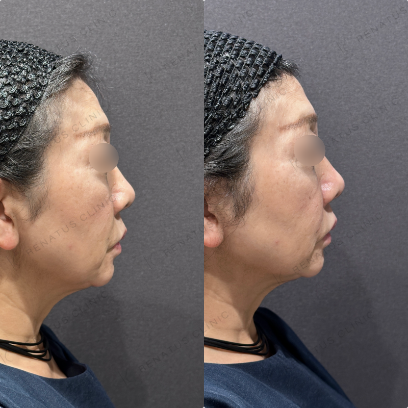 ほうれい線ヒアルロン酸ボリフト症例写真