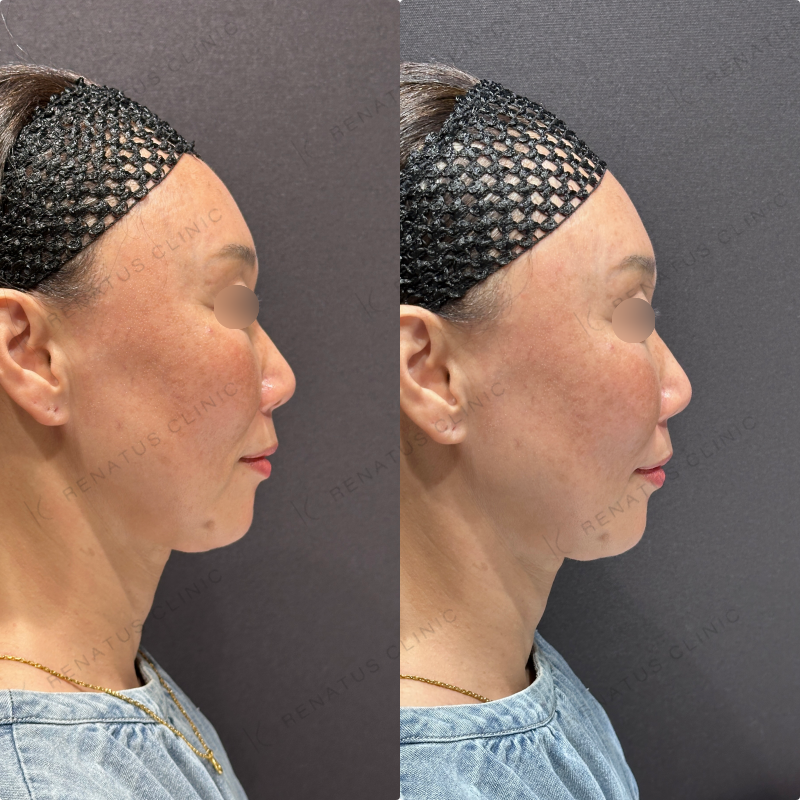 ほうれい線ヒアルロン酸ボリフト症例写真