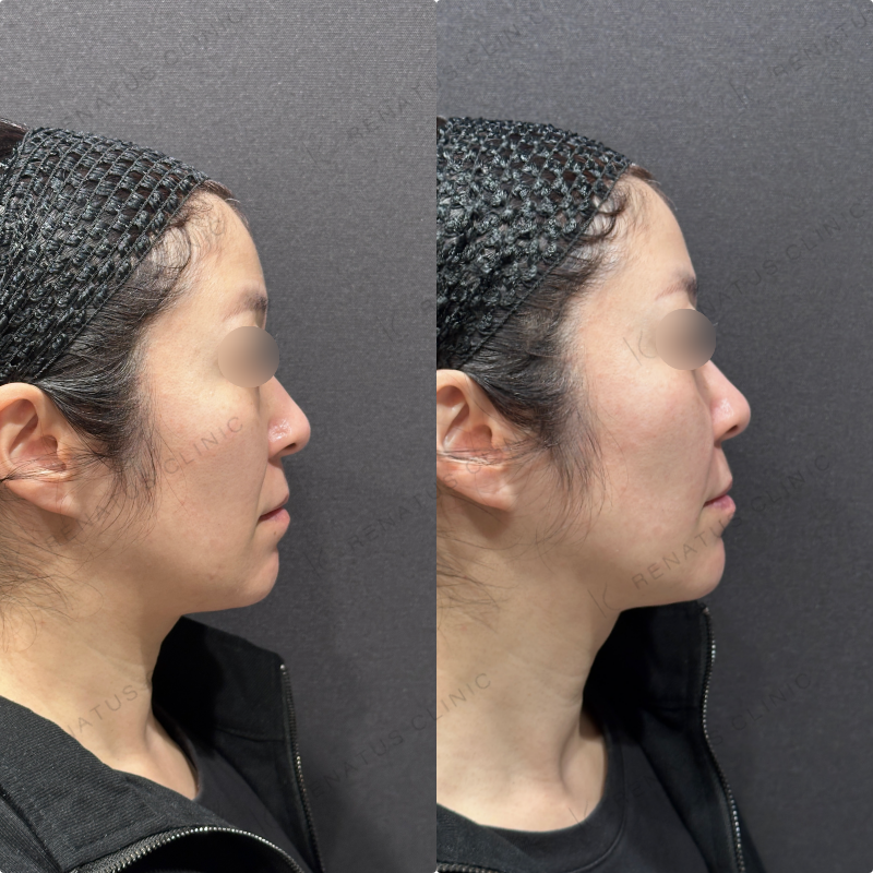 ほうれい線ヒアルロン酸ボリフト症例写真