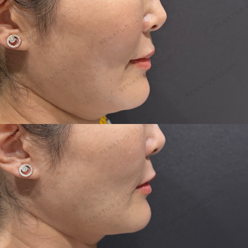 ほうれい線ヒアルロン酸ボリフト症例写真