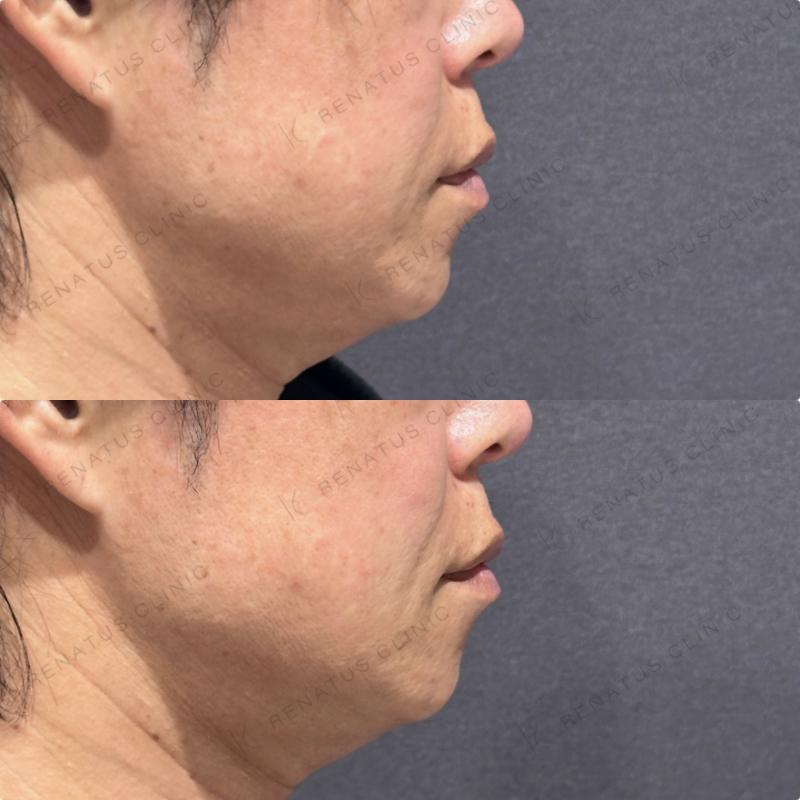 ほうれい線ヒアルロン酸ボリフト症例写真