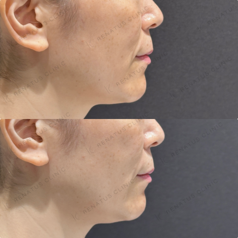 ほうれい線ヒアルロン酸ボリフト症例写真