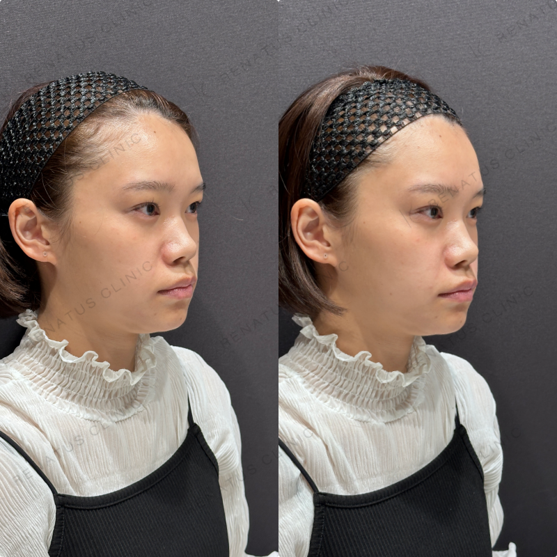 ほうれい線ヒアルロン酸ボリフト症例写真