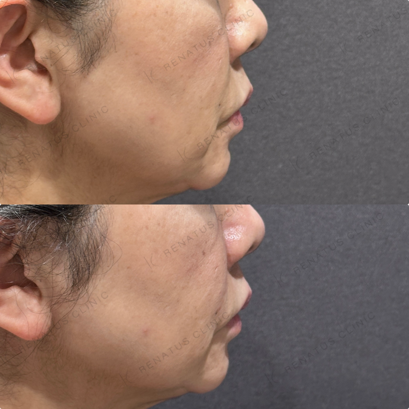 ほうれい線ヒアルロン酸ボリフト症例写真