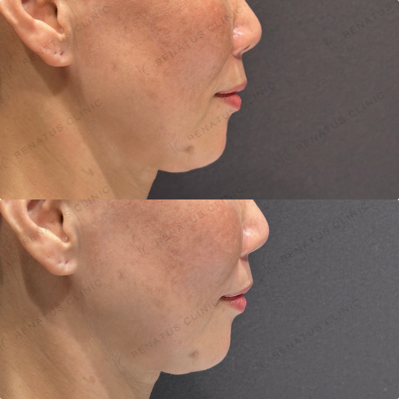 ほうれい線ヒアルロン酸ボリフト症例写真