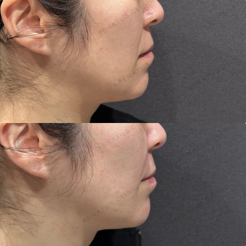 ほうれい線ヒアルロン酸ボリフト症例写真