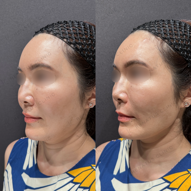 ほうれい線ヒアルロン酸ボリフト症例写真