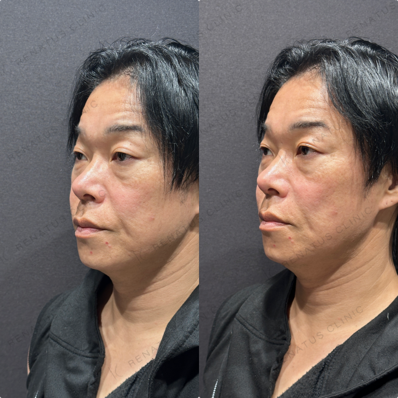 ほうれい線ヒアルロン酸ボリフト症例写真