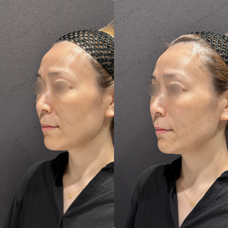 ほうれい線ヒアルロン酸ボリフト症例写真