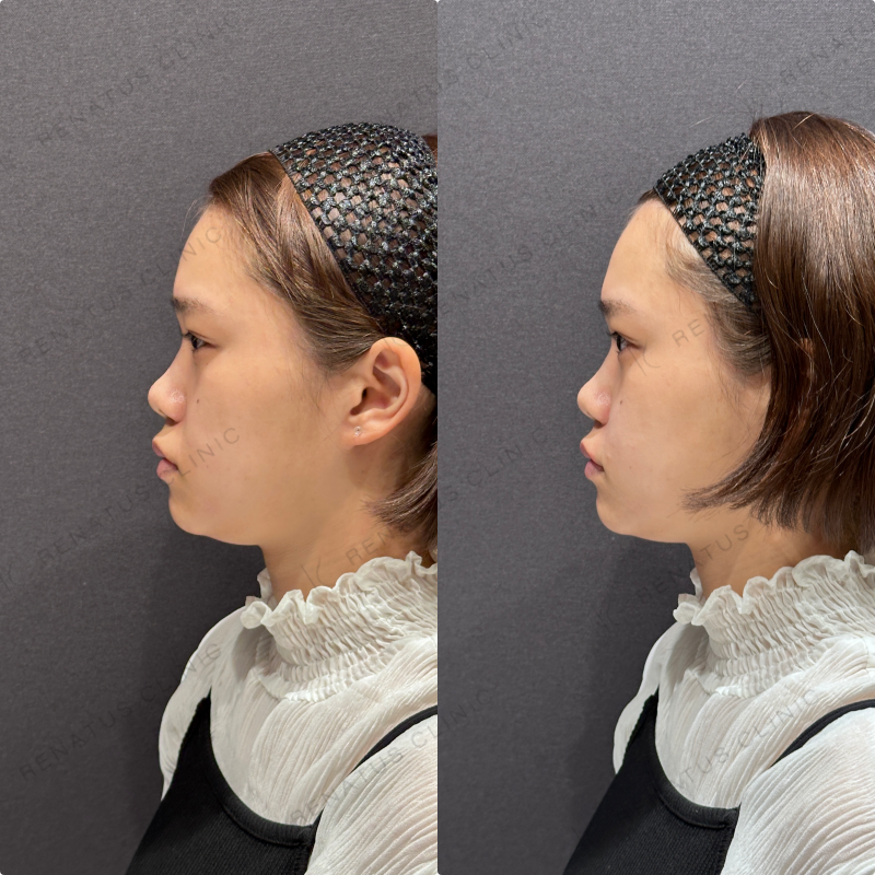 ほうれい線ヒアルロン酸ボリフト症例写真