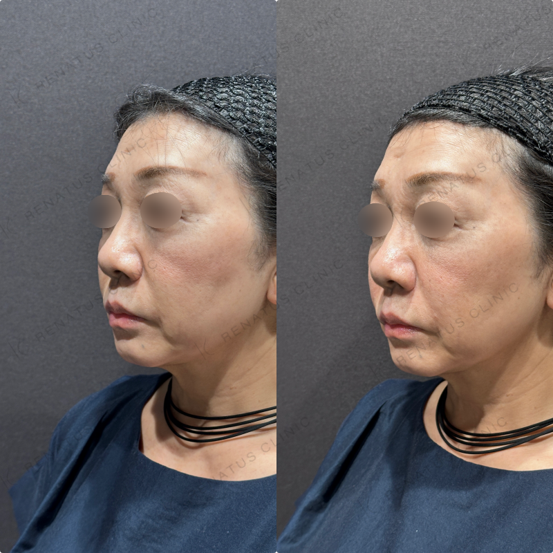 ほうれい線ヒアルロン酸ボリフト症例写真