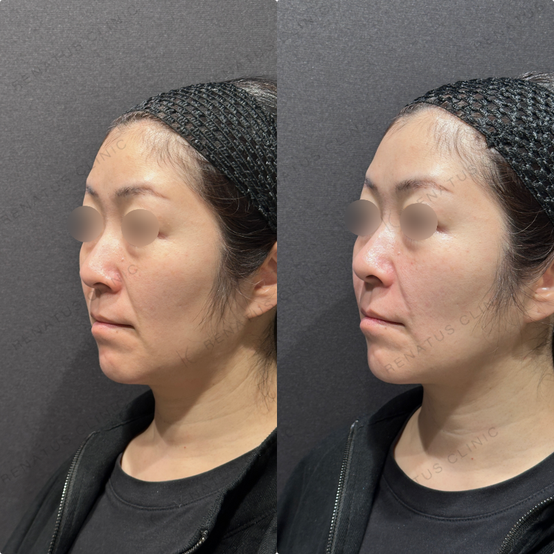 ほうれい線ヒアルロン酸ボリフト症例写真