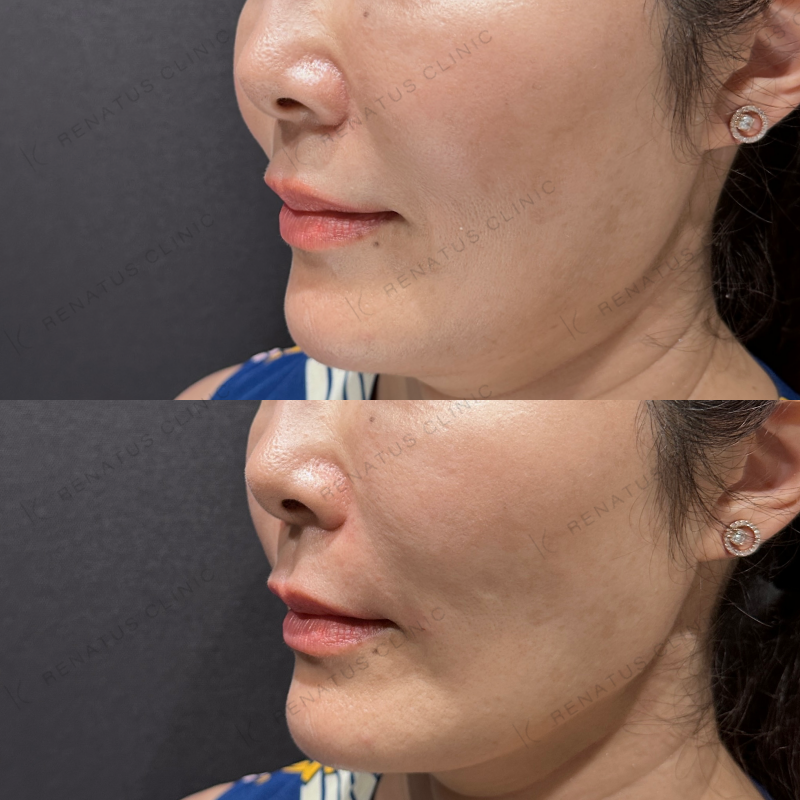 ほうれい線ヒアルロン酸ボリフト症例写真