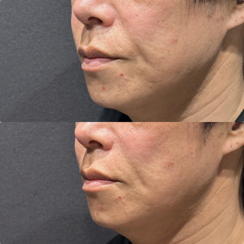 ほうれい線ヒアルロン酸ボリフト症例写真