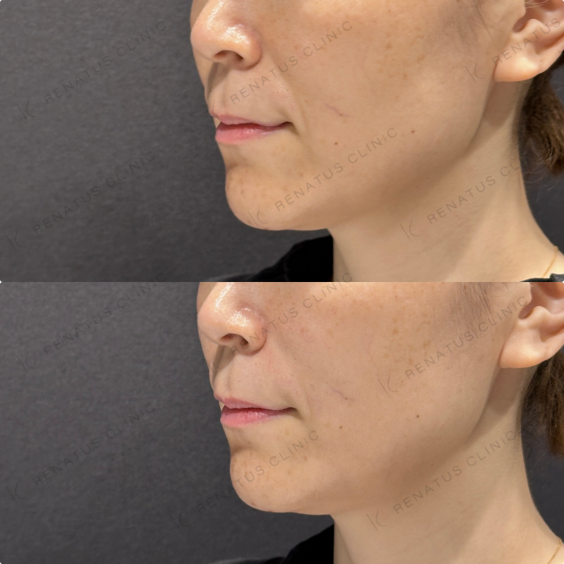 ほうれい線ヒアルロン酸ボリフト症例写真