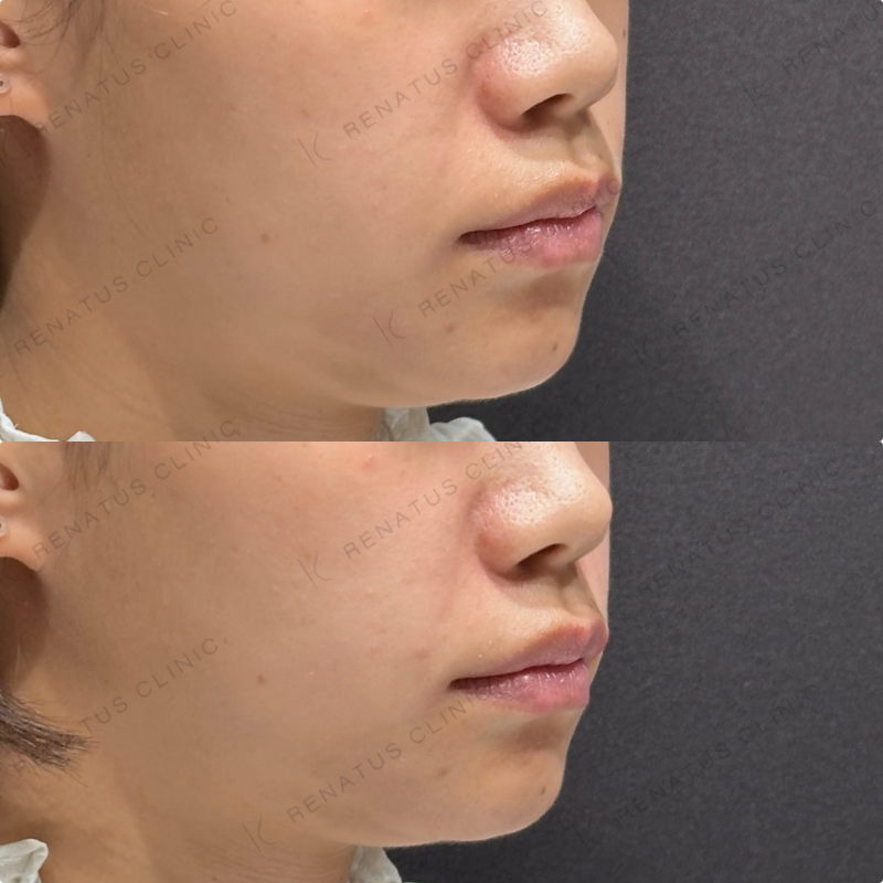 ほうれい線ヒアルロン酸ボリフト症例写真