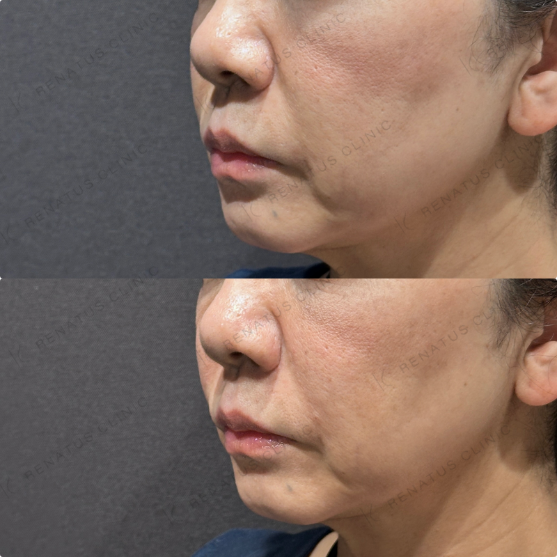 ほうれい線ヒアルロン酸ボリフト症例写真