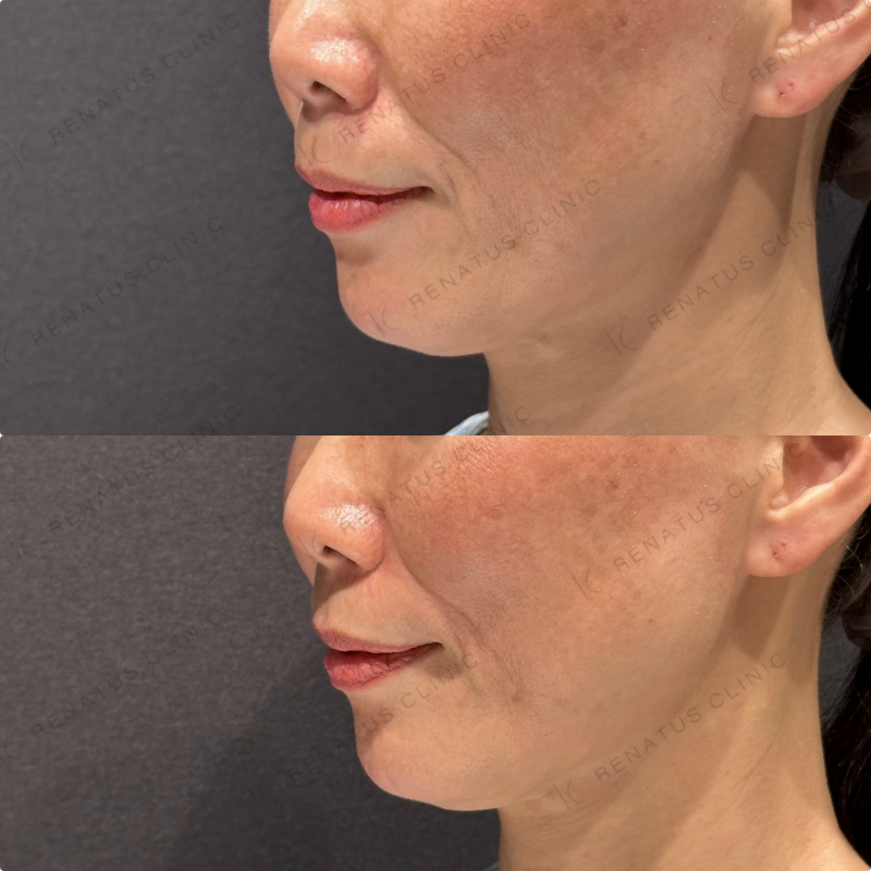 ほうれい線ヒアルロン酸ボリフト症例写真