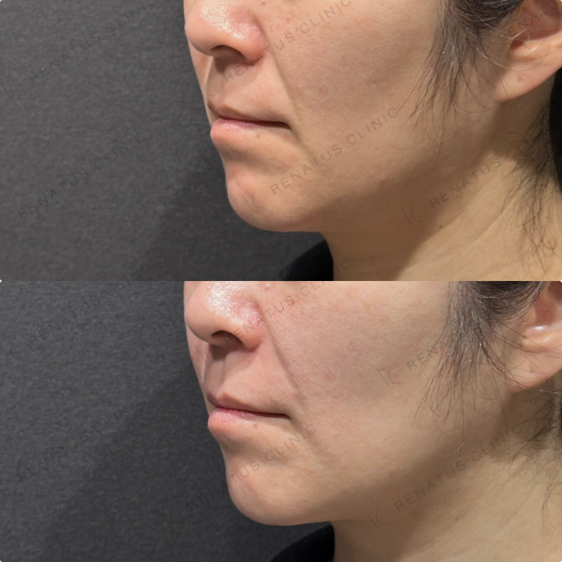 ほうれい線ヒアルロン酸ボリフト症例写真