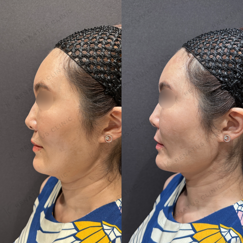 ほうれい線ヒアルロン酸ボリフト症例写真