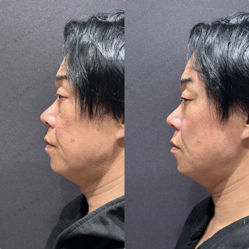 ほうれい線ヒアルロン酸ボリフト症例写真