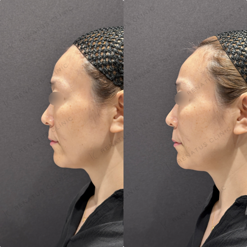 ほうれい線ヒアルロン酸ボリフト症例写真