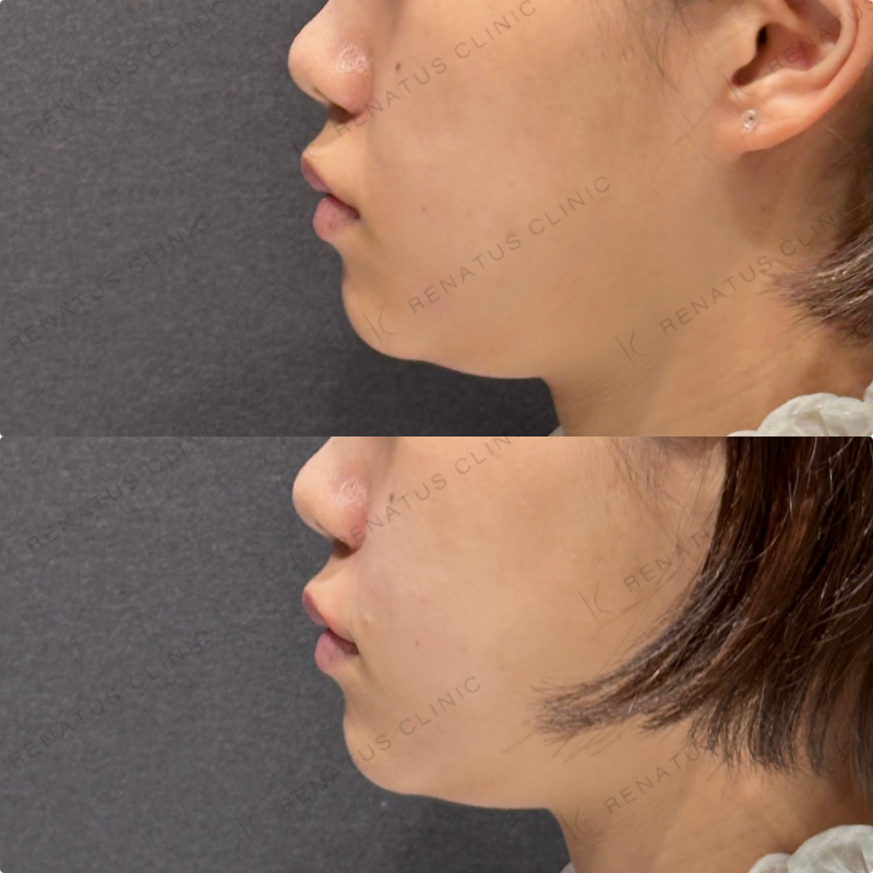 ほうれい線ヒアルロン酸ボリフト症例写真