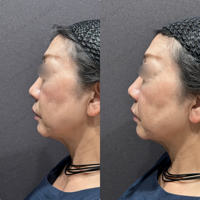 ほうれい線ヒアルロン酸ボリフト症例写真