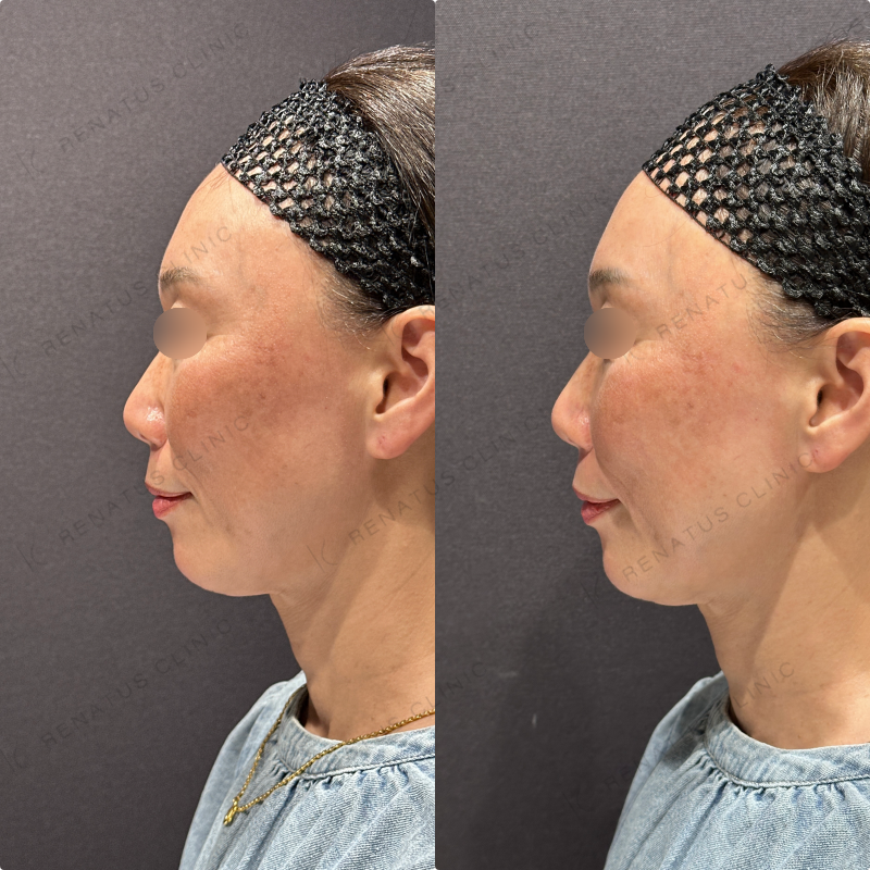 ほうれい線ヒアルロン酸ボリフト症例写真