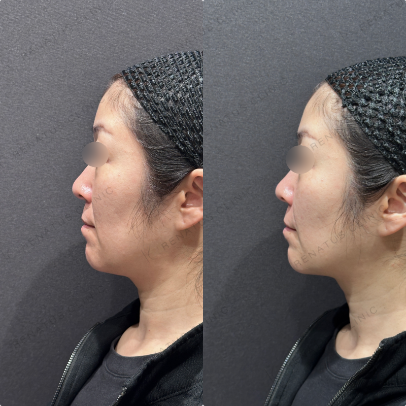 ほうれい線ヒアルロン酸ボリフト症例写真