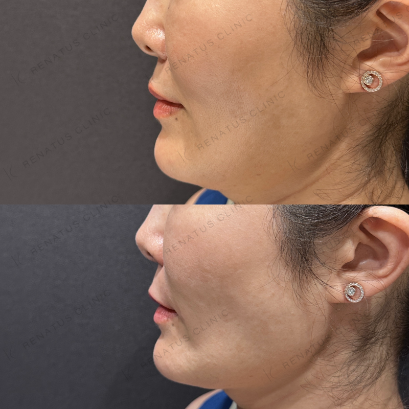 ほうれい線ヒアルロン酸ボリフト症例写真