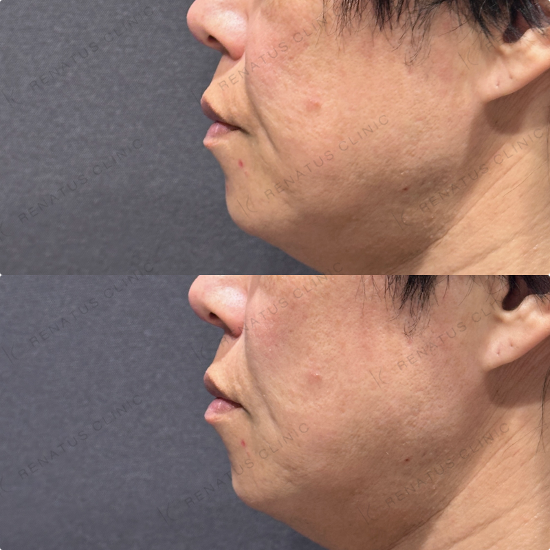 ほうれい線ヒアルロン酸ボリフト症例写真