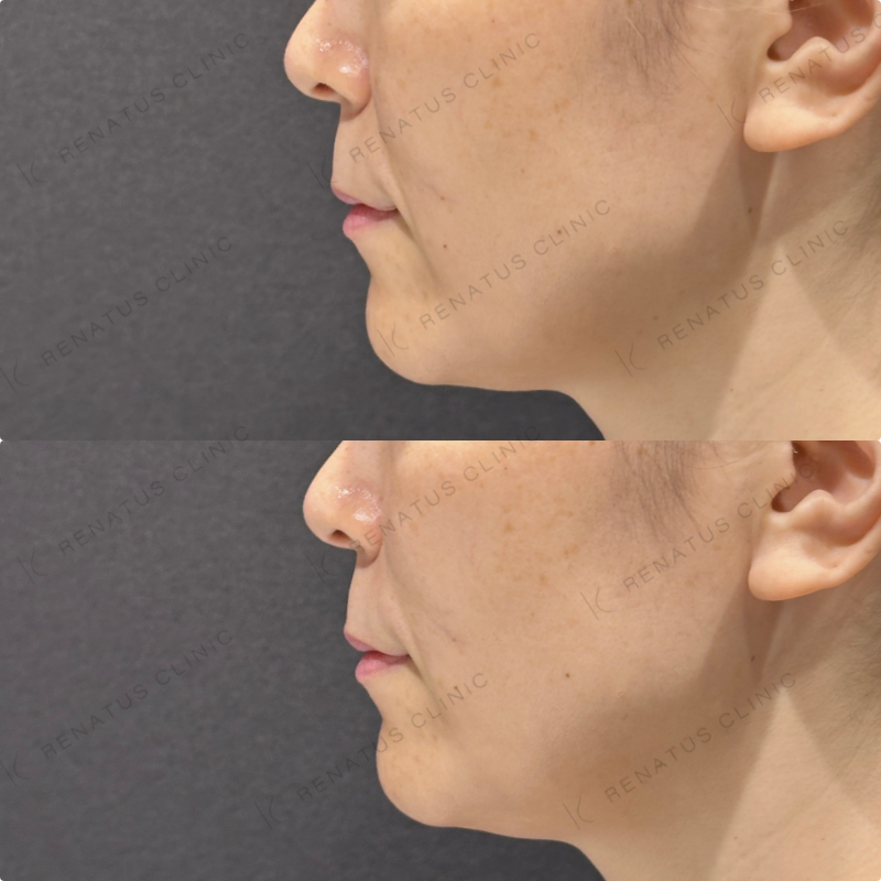 ほうれい線ヒアルロン酸ボリフト症例写真