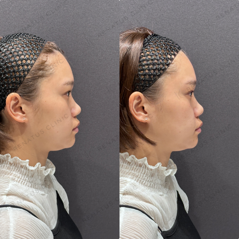 ほうれい線ヒアルロン酸ボリフト症例写真