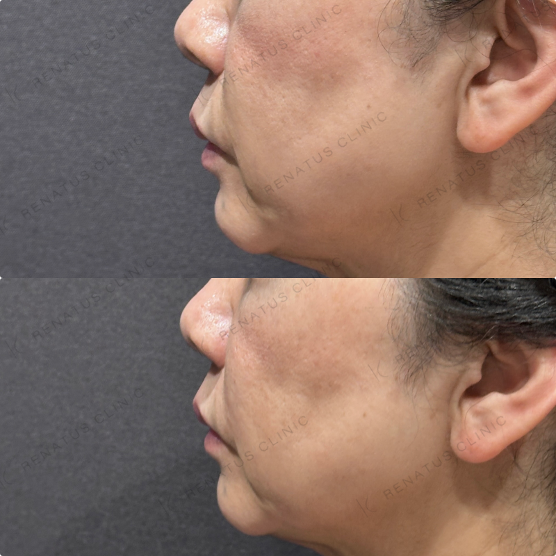 ほうれい線ヒアルロン酸ボリフト症例写真