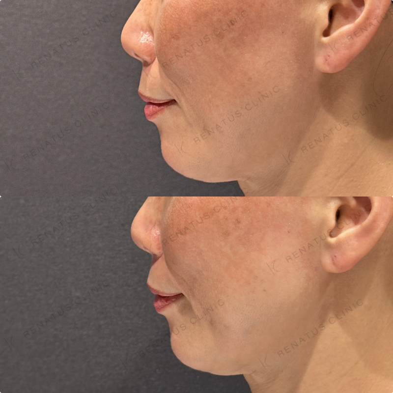 ほうれい線ヒアルロン酸ボリフト症例写真