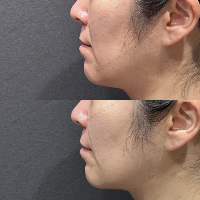 ほうれい線ヒアルロン酸ボリフト症例写真