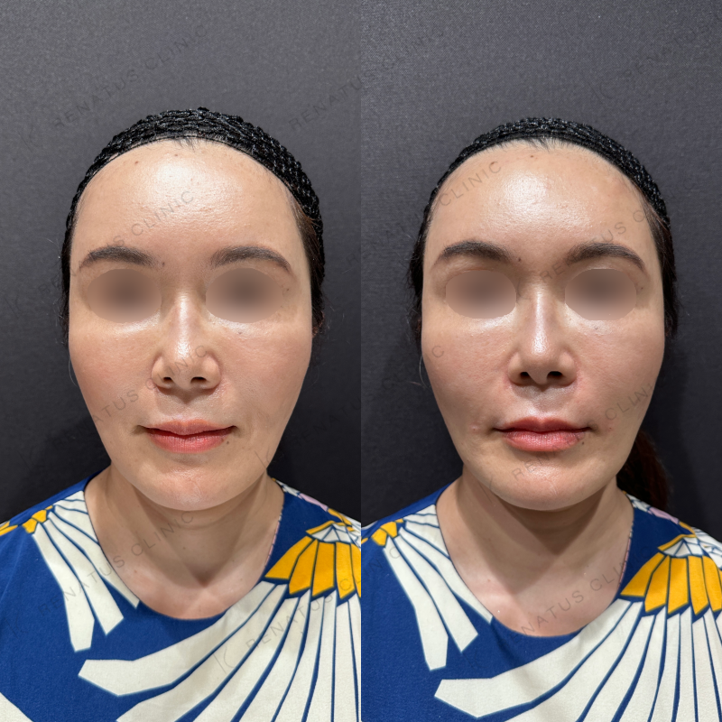 ほうれい線ヒアルロン酸ボリフト症例写真