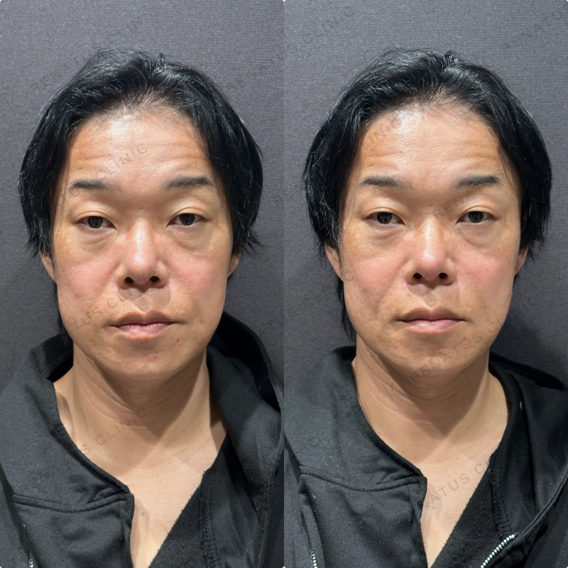 ほうれい線ヒアルロン酸ボリフト症例写真