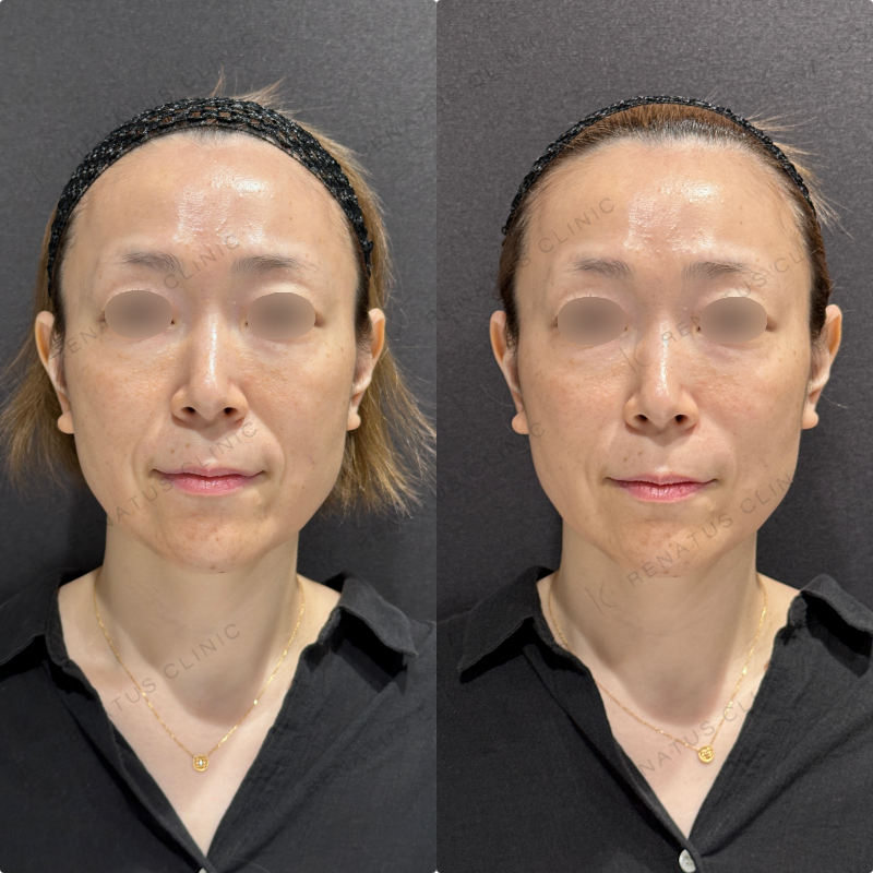 ほうれい線ヒアルロン酸ボリフト症例写真