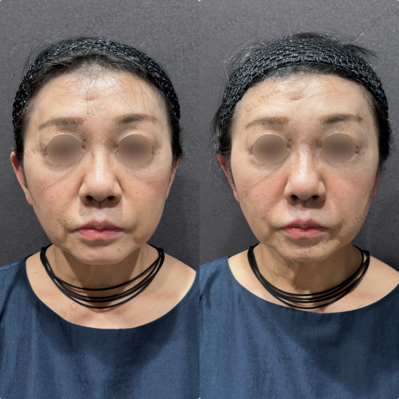 ほうれい線ヒアルロン酸ボリフト症例写真