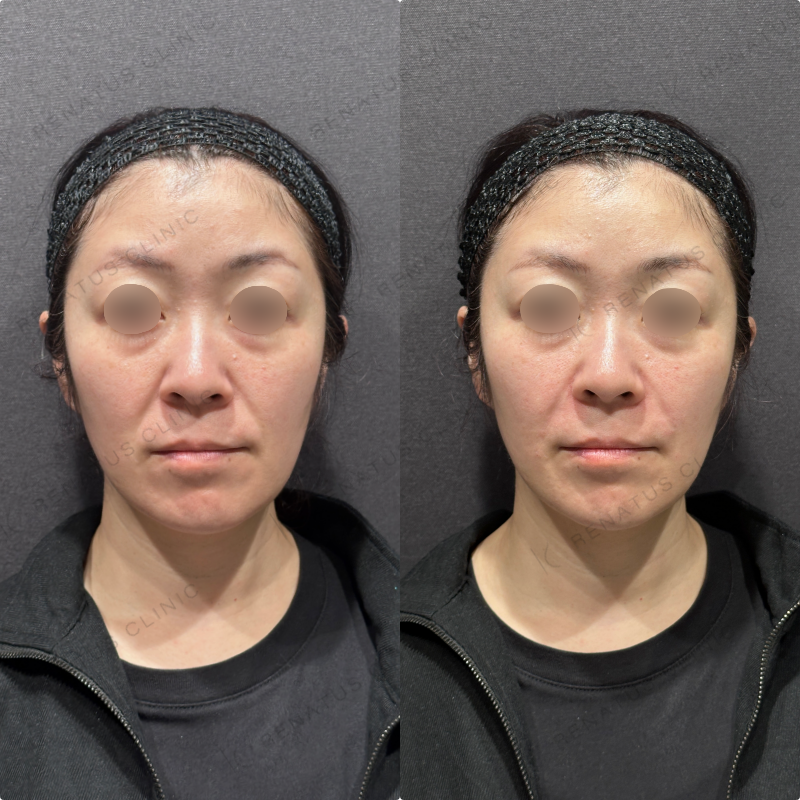 ほうれい線ヒアルロン酸ボリフト症例写真