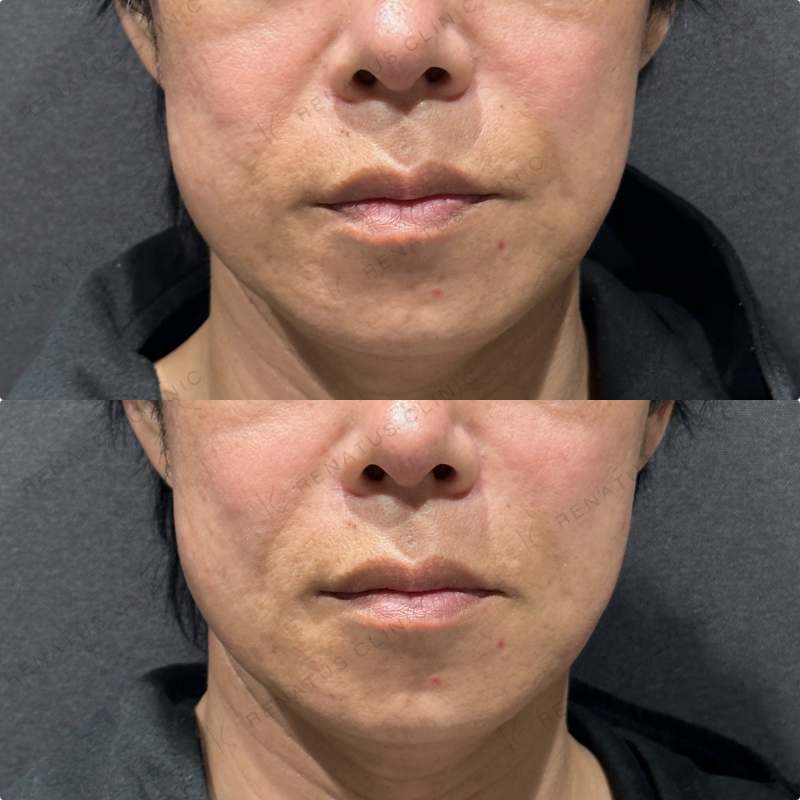 ほうれい線ヒアルロン酸ボリフト症例写真